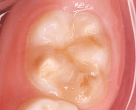 Emaljehypoplasi